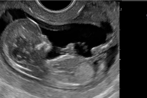 Echographe Gynécologie obstétrique Image clinique