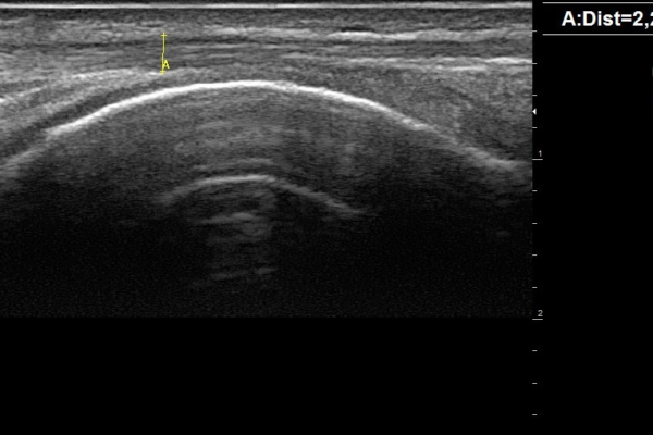 Echographie musculosquelettique Image clinique