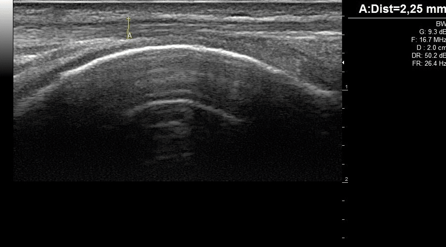 Echographie musculosquelettique Image clinique