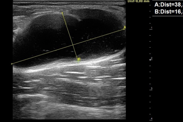 Echographie musculosquelettique Image clinique