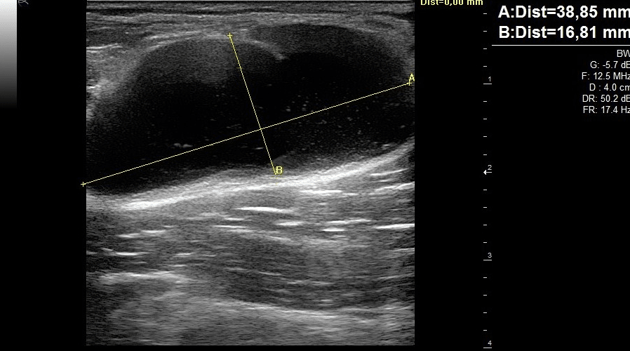 Echographie musculosquelettique Image clinique