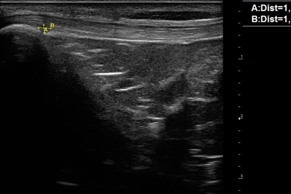 Echographie musculosquelettique Image clinique