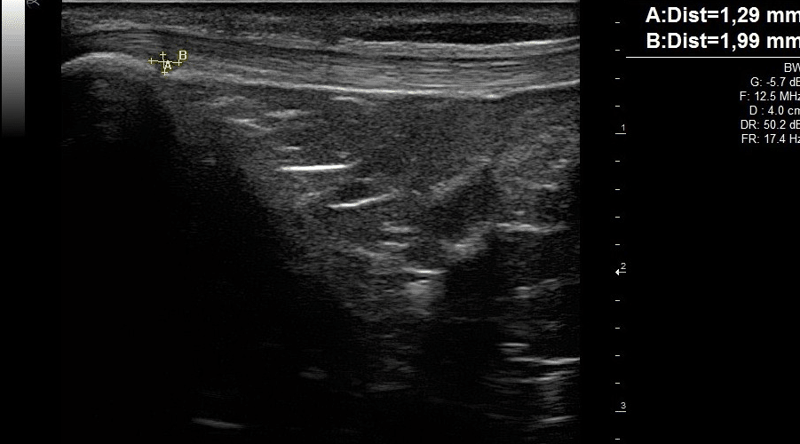 Echographie musculosquelettique Image clinique