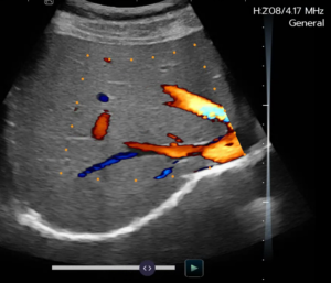 Doppler Couleur optimisé par IA