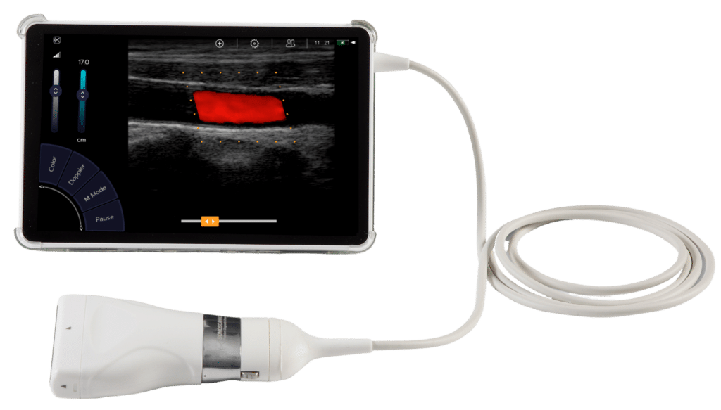 échographe ultraportable Sonoscanner pour réaliser une recherche de tvp