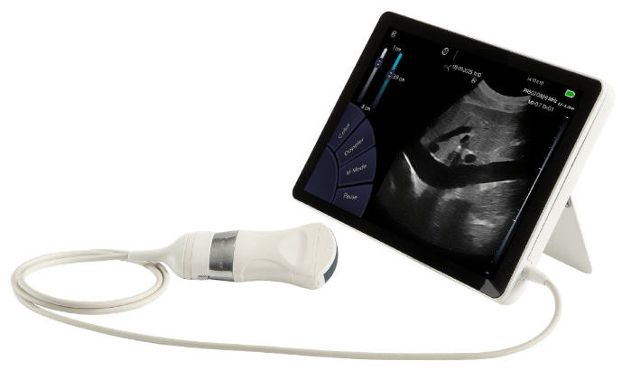échographe ultraportable Sonoscanner pour échographie phlébite