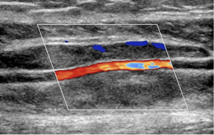 image clinique de Thrombophlébite des deux veines gastrocnémiennes