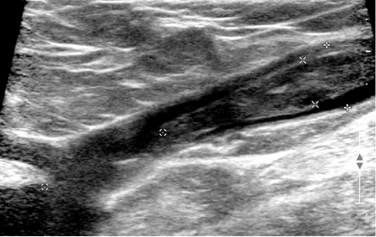 thrombus flottant crosse grande saphène échographie