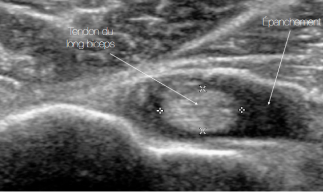Epanchement intra-articulaire autour du tendon du long-biceps