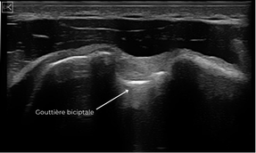 Tendon du long biceps