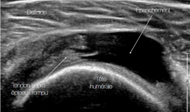Rupture complète du tendon du supra-épineux